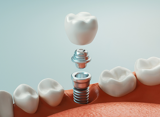 Illustrated dental implant and crown being placed in lower jaw