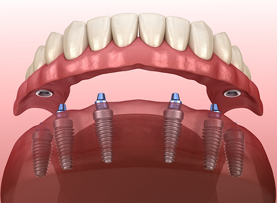 Illustrated full denture being placed onto six dental implants