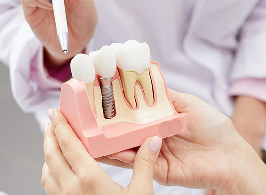 Dentist showing a model of a dental implant to a patient