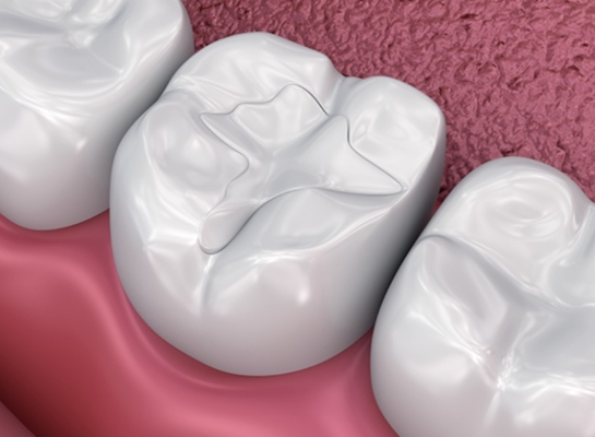 Illustrated row of teeth with dental sealants