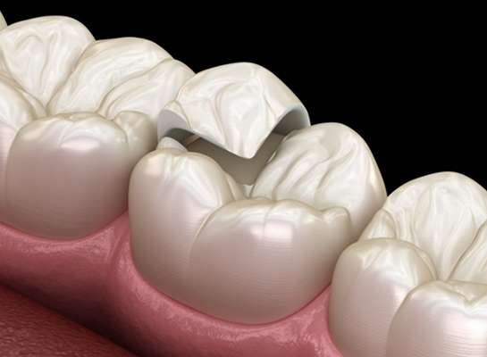 Illustrated onlay being placed to repair a broken tooth