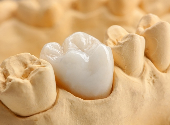 White dental crown covering a tooth in a model of the mouth