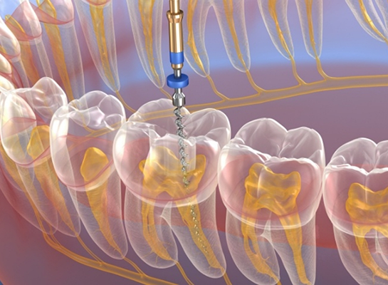 Illustrated dental instrument treating the inside of a tooth