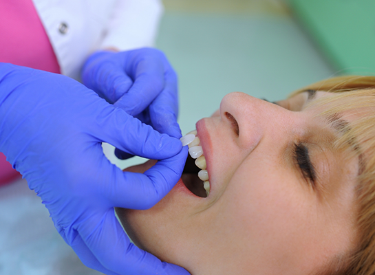 Cosmetic dentist placing a veneer over a tooth