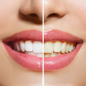 Closeup of woman’s smile that’s half whitened